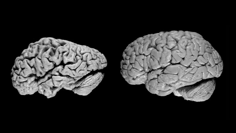 Alzheimer-brain